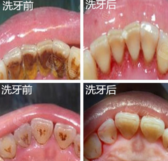 洗牙前后对比照