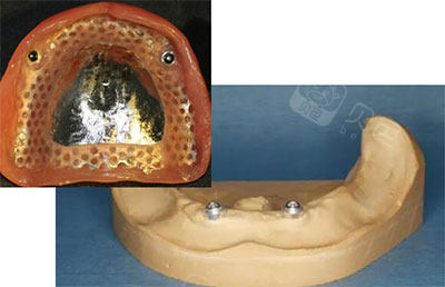 全口种植覆盖义齿