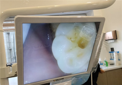 景德镇民利口腔补牙实拍