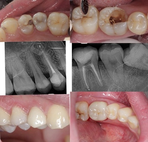 烤瓷牙套里的牙会烂吗?为什么我做完烤瓷牙会发黑发臭?