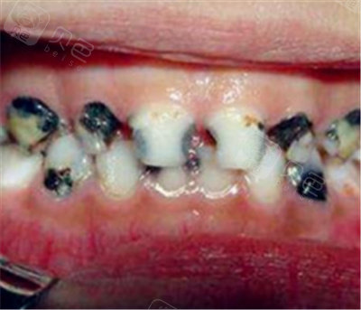 孩子牙齿被蛀空了怎么办?您知道刚开始蛀牙怎么补救吗?