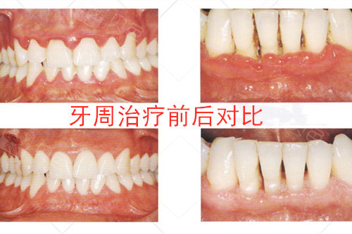 杭州雅乐口腔牙周治疗前后对比