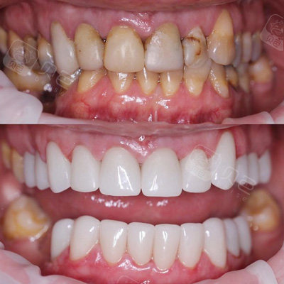 琥珀瓷贴面修复前后对比