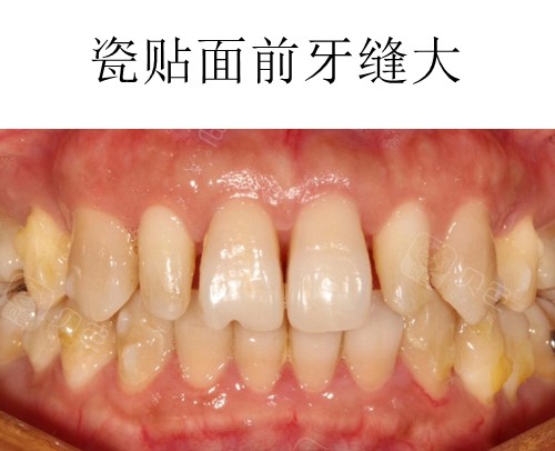 牙缝大瓷贴面修复后我后悔了,贴面前建议先听听我的经历
