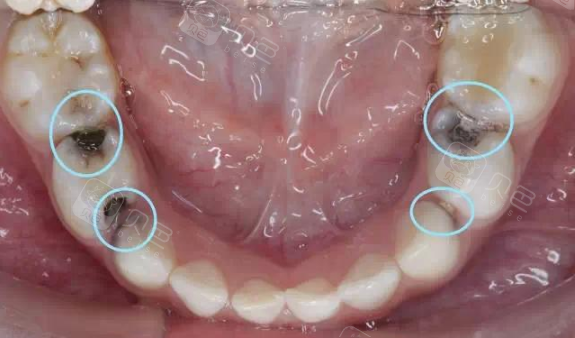 冲牙器适合哪些人群?邻面龋牙周炎矫正期可以使用吗?