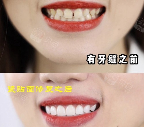 牙缝大的做瓷贴面修复前后效果对比图