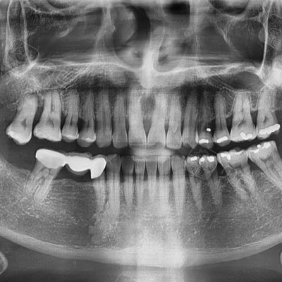 检查项目包括口腔检查,口腔ct,口腔全景片,便于查看牙齿,牙槽骨,种植