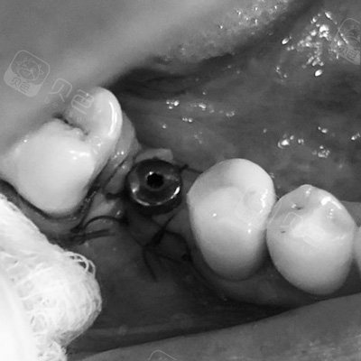 愈合帽安装后需要给植体和牙槽骨一定时间进行恢复,此时种植牙一期