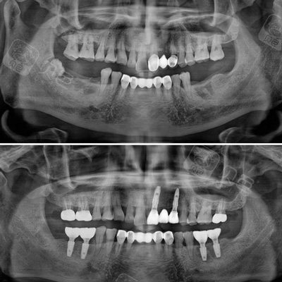 带你了解杭州种植牙补贴真相!
