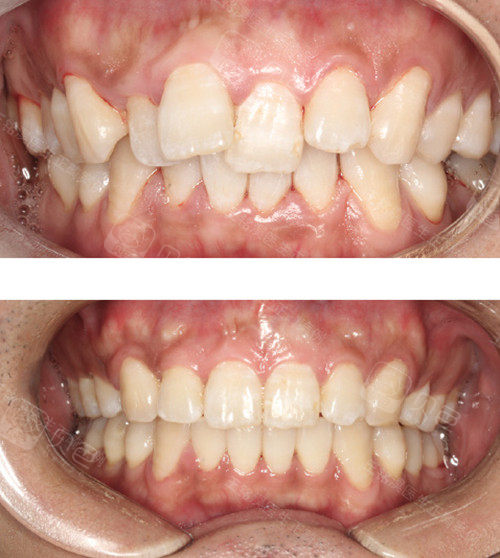 杭州牙齿矫正医生推荐,美奥口腔王铭淏医生舌侧矫正案例!
