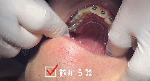 厦门登特口腔南祥明医生牙齿矫正佩戴上颌扩弓器