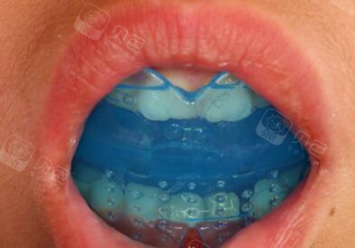 mrc儿童牙齿早期干预大概需要多钱?多久能见效? - 贝色口腔