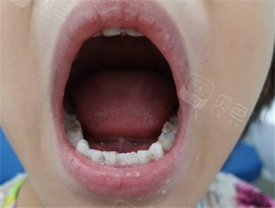 江门优益口腔龋齿 span style=