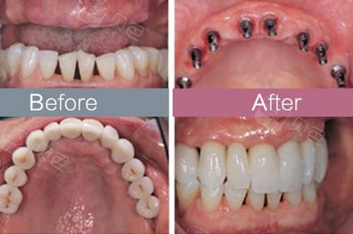 沈阳马泷口腔种植牙前后对比图