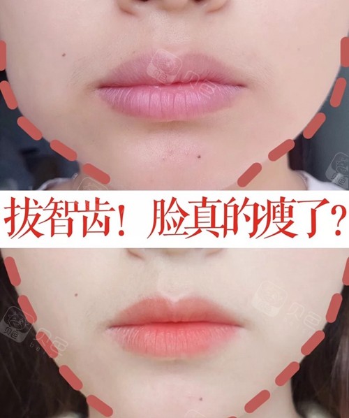 拔掉智齿真的会改变脸型瘦脸吗?