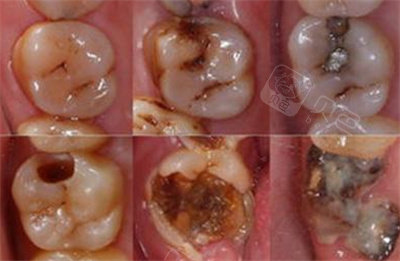 千万不要去补牙洞!亲生经历龋齿补牙就是个骗局!