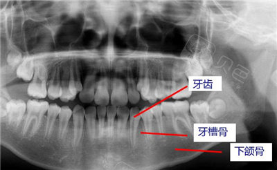 牙槽骨CT图