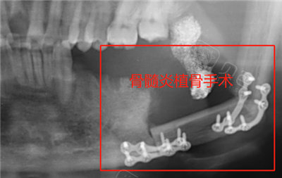 骨髓炎植骨手术CT图