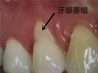 牙龈萎缩图