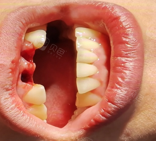 两颗大门牙磕断缺失,记录我拔牙以及一期种植手术过程