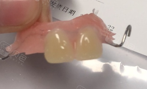 两颗大门牙磕断缺失,记录我拔牙以及一期种植手术过程