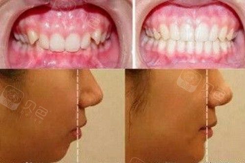 从深覆合矫正脸型前后变化对比图看矫正效果好不好