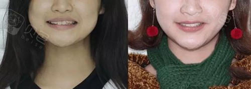 从深覆合矫正脸型前后变化对比图看矫正效果好不好