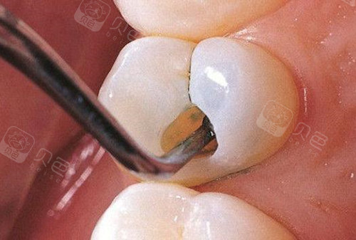 虫牙怎么治才好是补好还是拔掉取决于这些情况