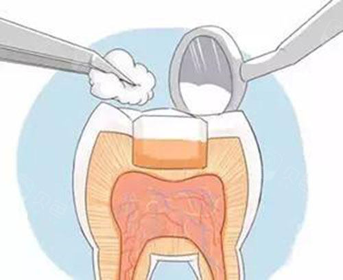 洗牙动画示意图