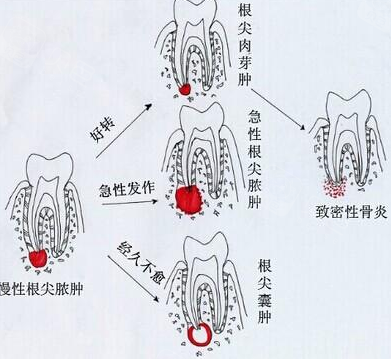 根尖炎