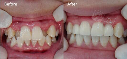 尤其是虎牙的矫正