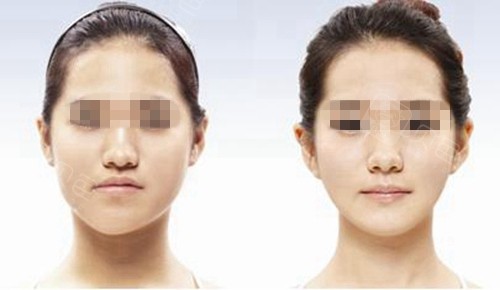 偏颌做正颌手术前后对比图