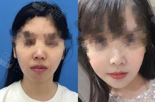 正颌手术案例分享