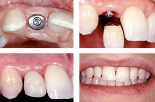 上海种植牙一颗多少钱明细,包含植体牙冠骨粉详细费用表!