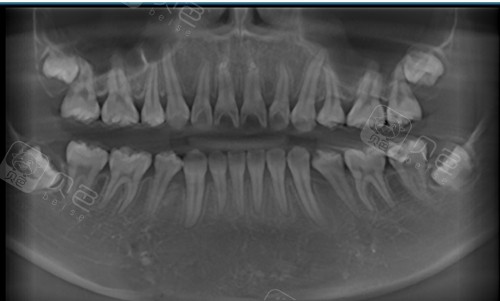 牙齿矫正术前拍摄口腔ct