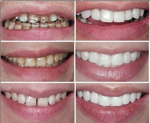 3m树脂补牙材料z250和z350,p60有什么区别?补牙和贴面哪个好?