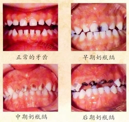宝宝在喝奶时,奶粉容易附着在牙齿表面,而且很多孩子都是吃着奶就可能