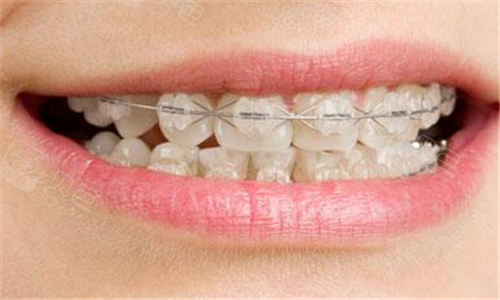 金属托槽,隐形矫正器价格分享!