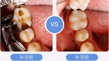 补牙前后对比