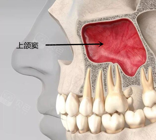 哪些情况需要做上颌窦提升上颌窦提升后多久可以种植牙