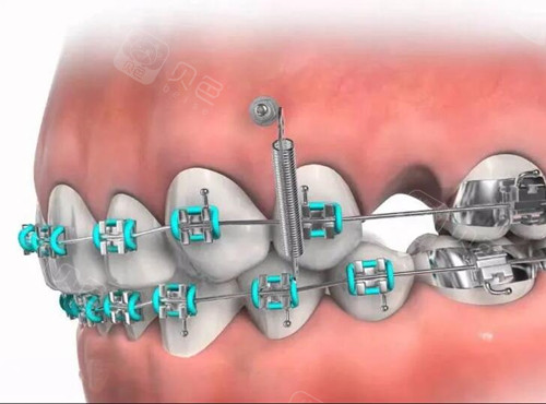 骨钉打在哪个位置?戴牙套打疼吗?支抗钉取出后有洞吗