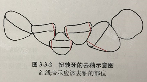 牙齿扭转矫正的片切示意图