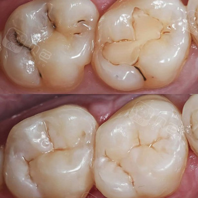 补牙前后对比