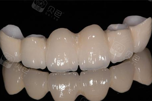 全瓷牙套图片展示