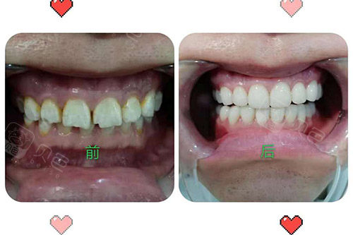牙齿贴面修复前后对比图