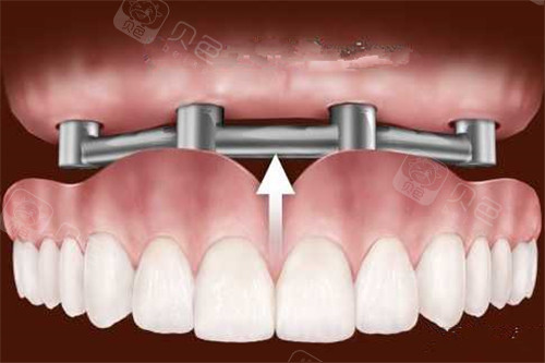 种植覆盖义牙方式示意图