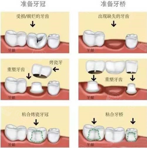 镶牙过程图解