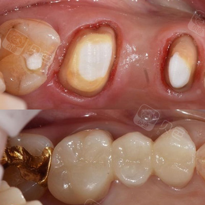 你知道厦门全瓷牙多少钱一颗吗?带你了解厦门全瓷牙价格!