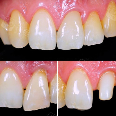 门牙全瓷冠修复