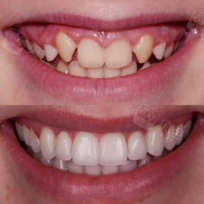 牙齿修复前后对比